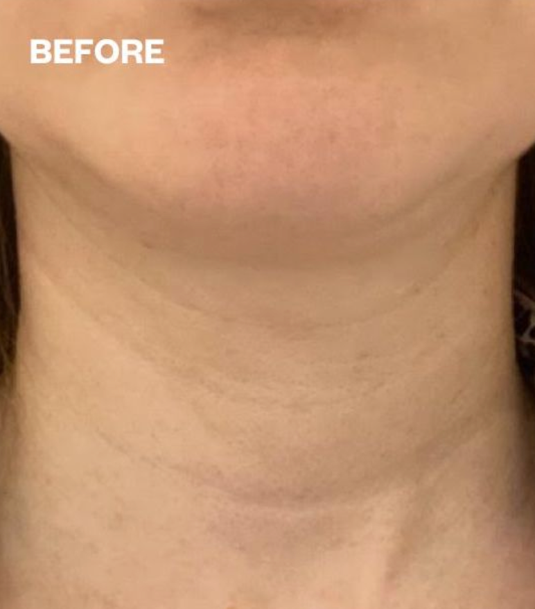 No More Wrinkles Neck Patch