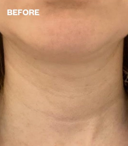 No More Wrinkles Neck Patch