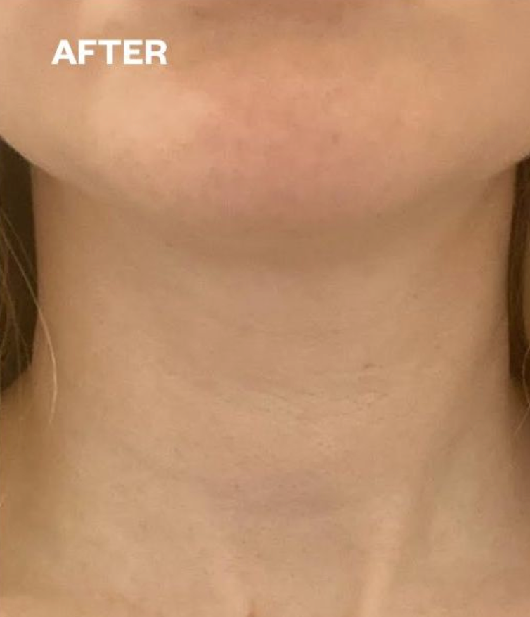 No More Wrinkles Neck Patch