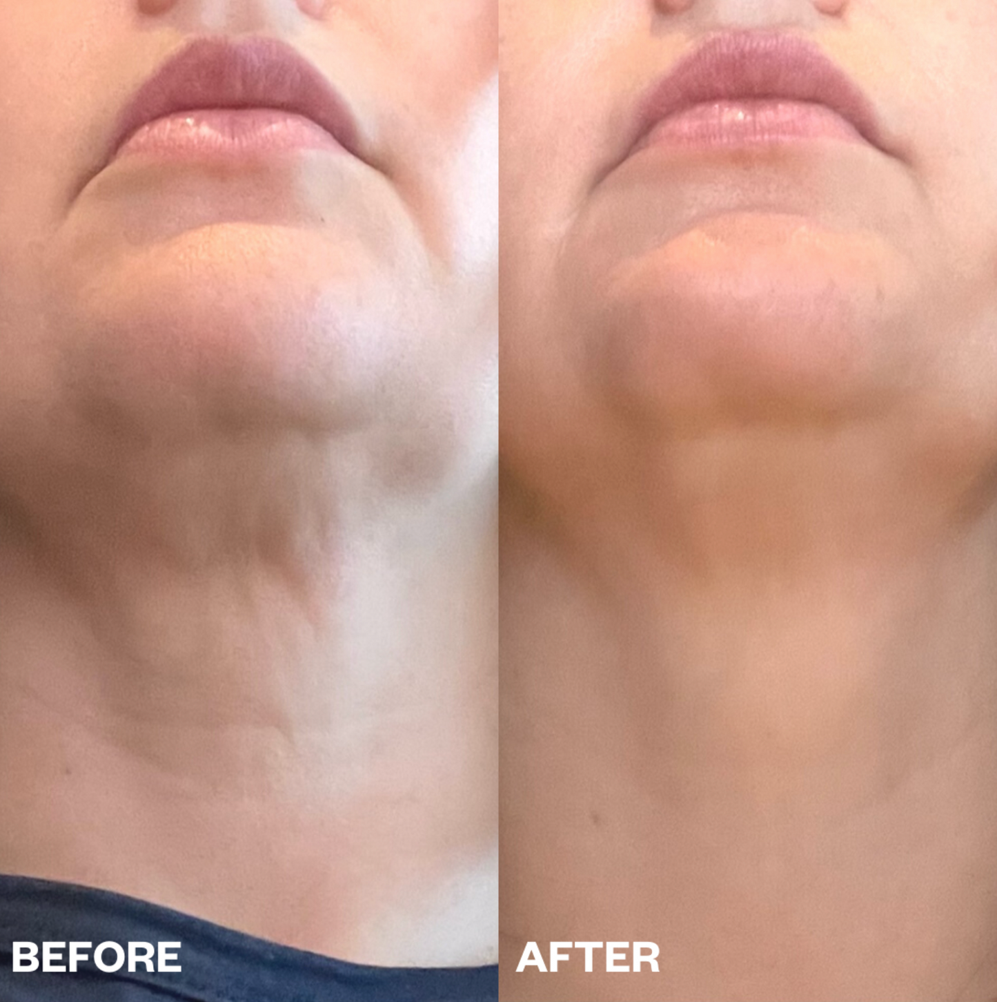 No More Wrinkles Neck Patch
